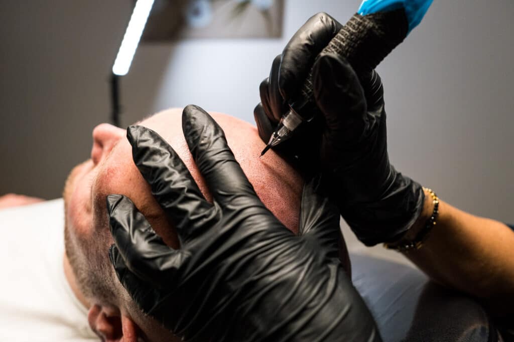 Technique de micropigmentation capillaire Geste de tricopigmentation capillaire sur un cuir chevelu