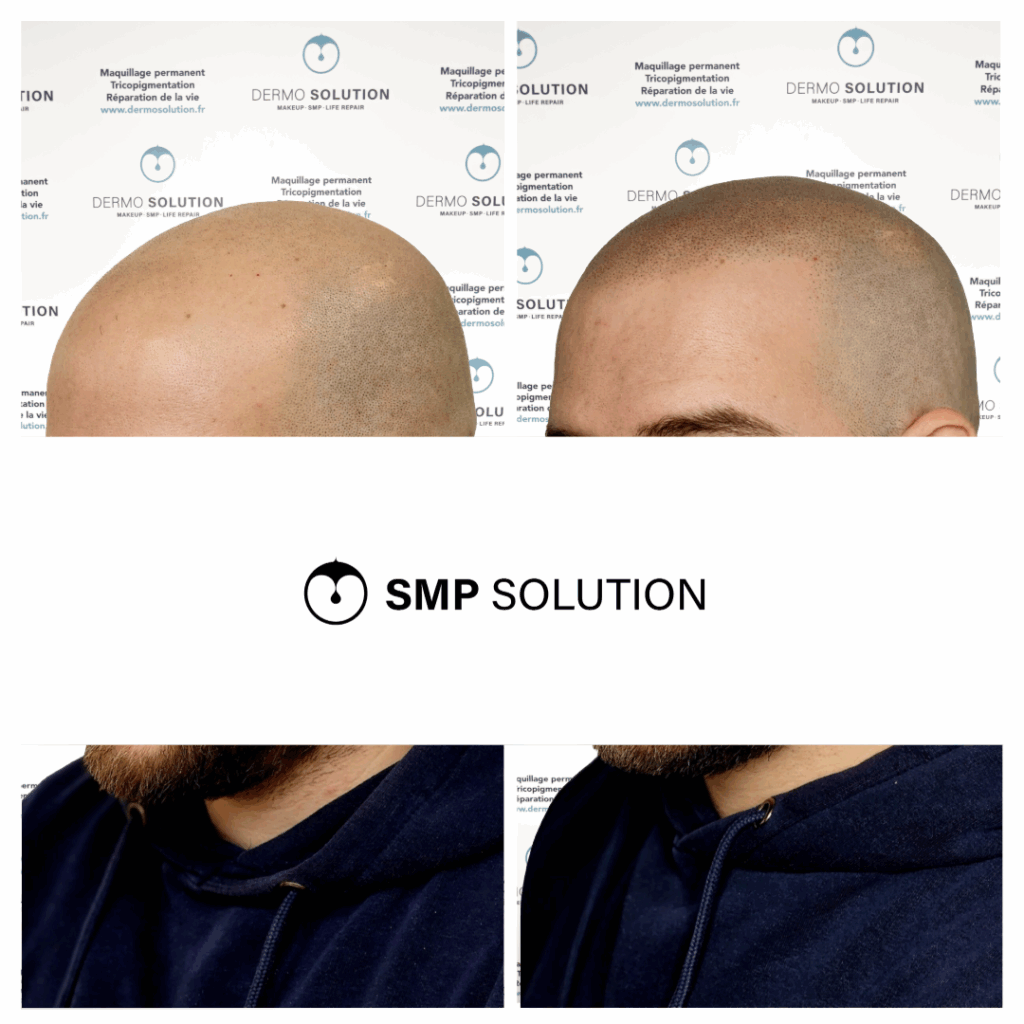 Avant après tricopigmentation effet rasé – profil Avant et après une tricopigmentation effet rasé, vues de profil