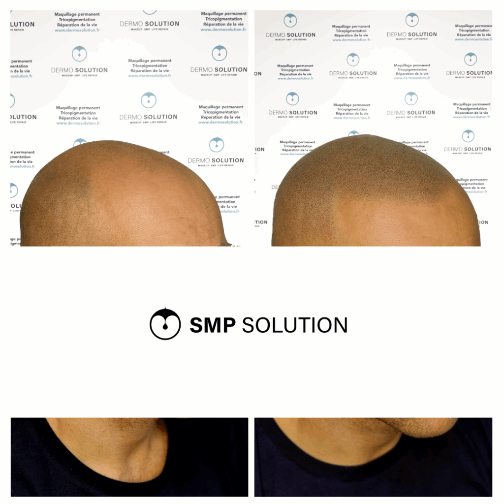 Solution calvitie : résultat avant après Comparaison avant après d'une solution de calvitie par tricopigmentation