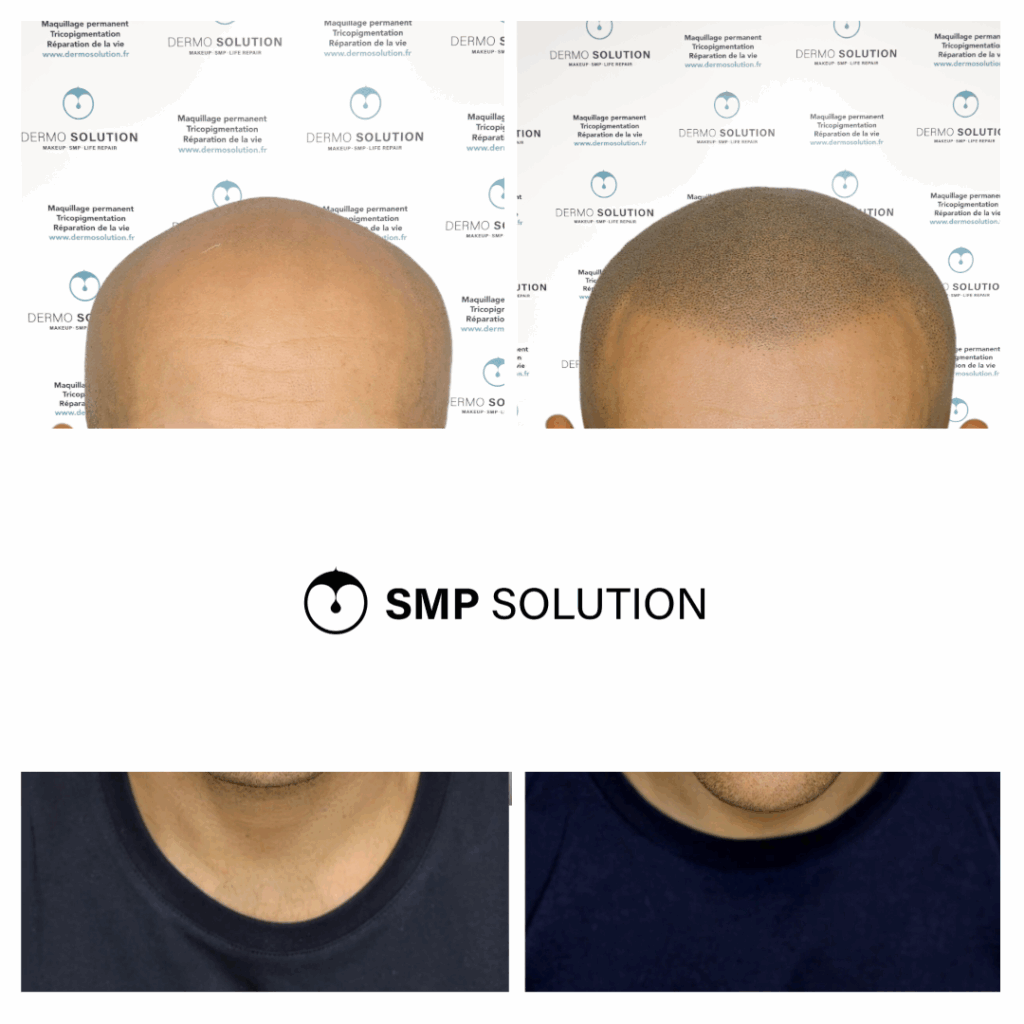 Effet rasé : avant après sur le dessus du crâne Avant après d'un effet rasé sur une calvitie du dessus de la tête