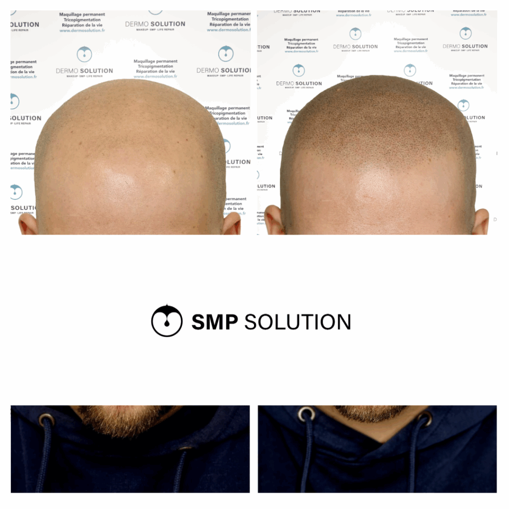 Tricopigmentation du sommet du crâne – avant après Comparaison du sommet du crâne avant et après tricopigmentation