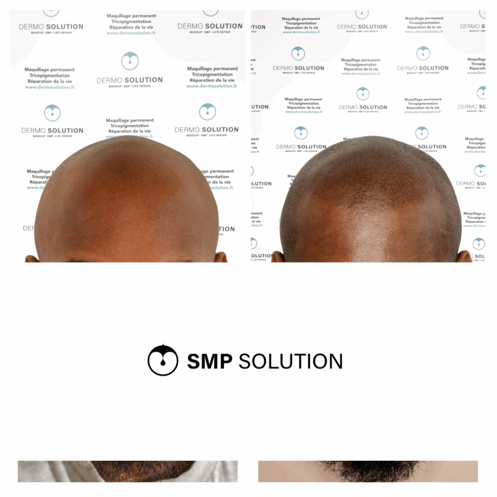 Avant après tricopigmentation – arrière du crâne Arrière du crâne avant et après une tricopigmentation effet rasé