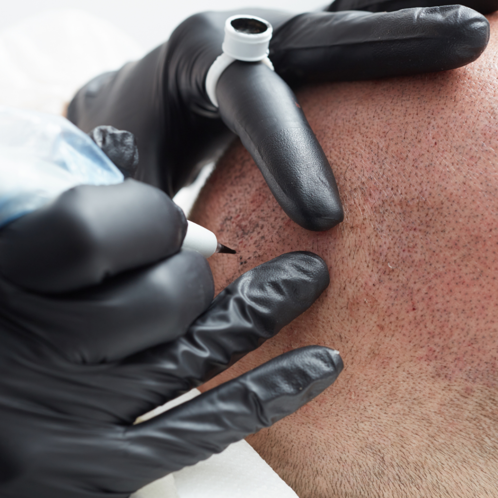 Séance de tricopigmentation capillaire Main gantée réalisant une tricopigmentation sur un cuir chevelu