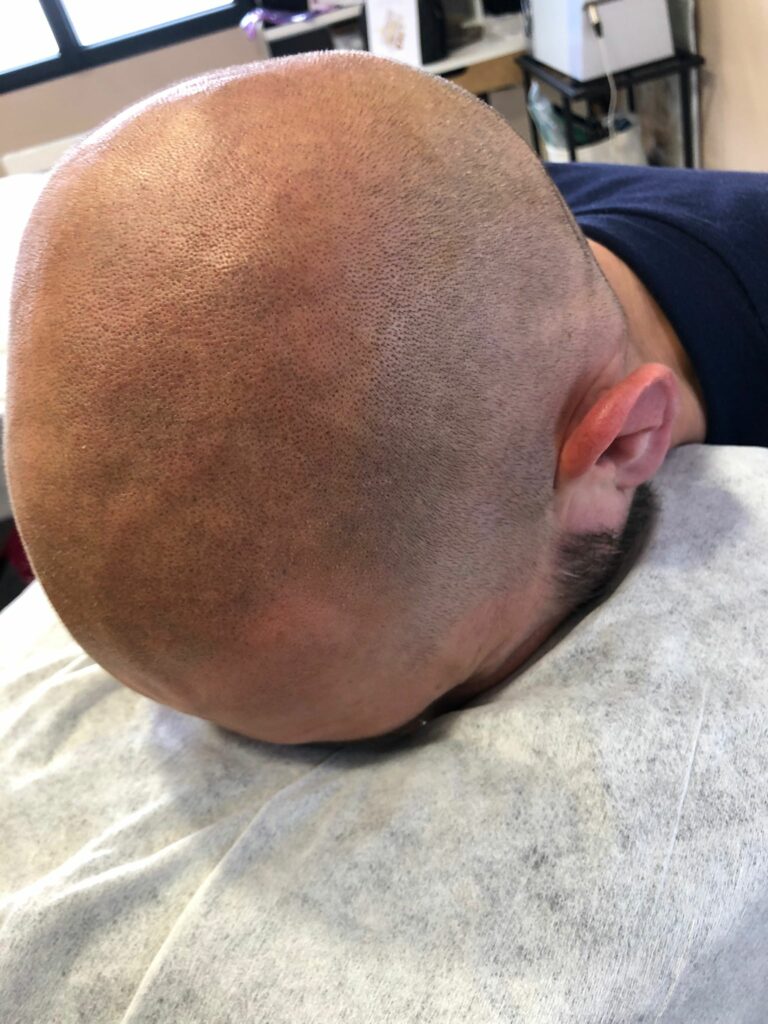 Cuir chevelu avec résultat de tricopigmentation effet rasé